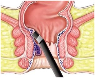 Laser Treatment for Anal Fissure