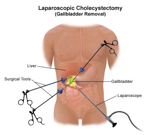 Laparoscopic Gallbladder Removal