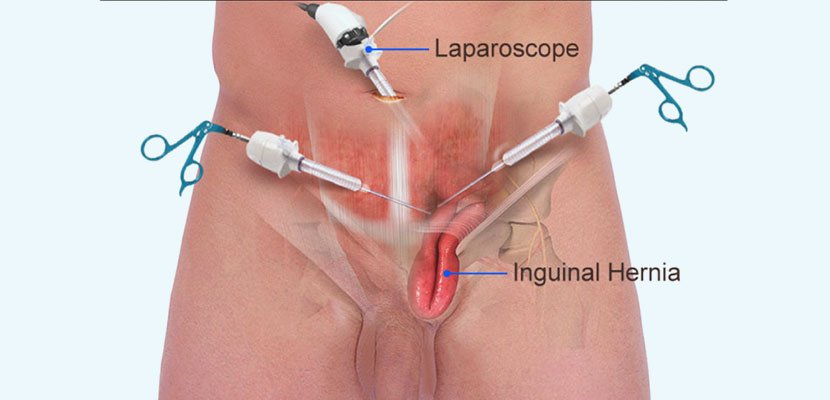 Laparoscopic Hernia Surgery