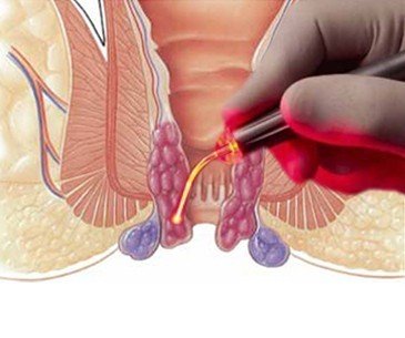Laser Treatment for Piles