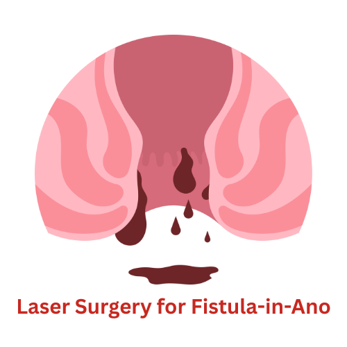 Laser Surgery for Fistula-in-Ano