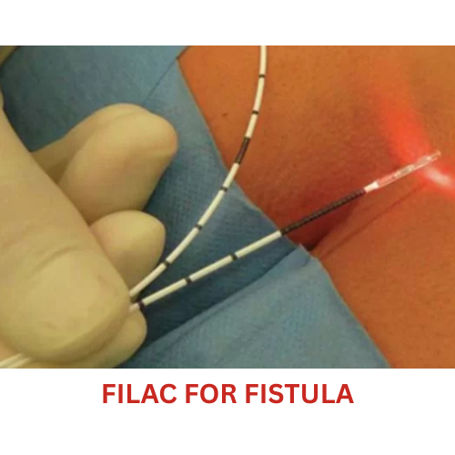 FiLaC for Fistula