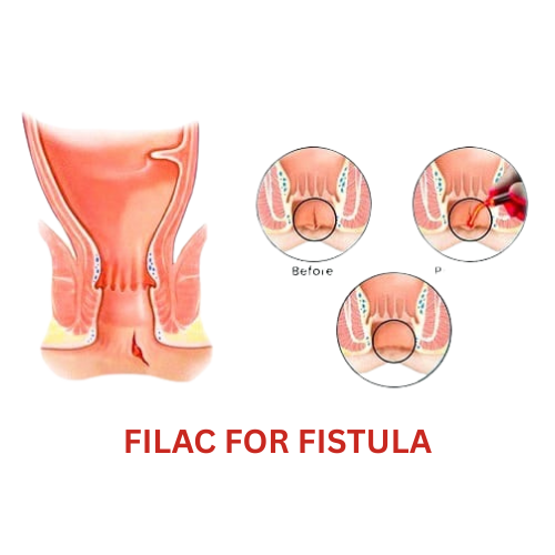 Laser Treatment for Anal Fissure