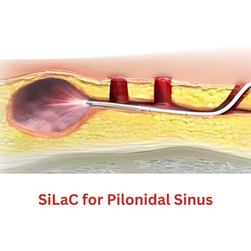 SiLaC for Pilonidal Sinus