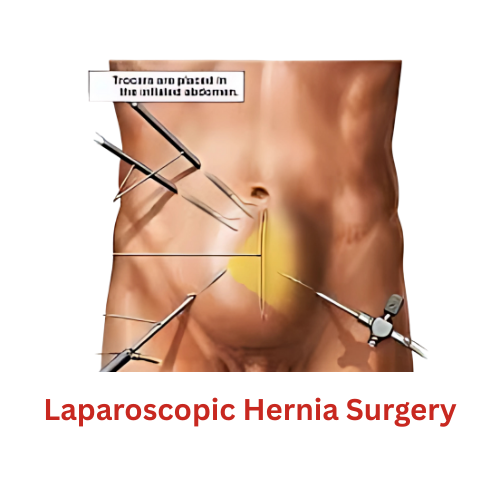 Laparoscopic Hernia Surgery