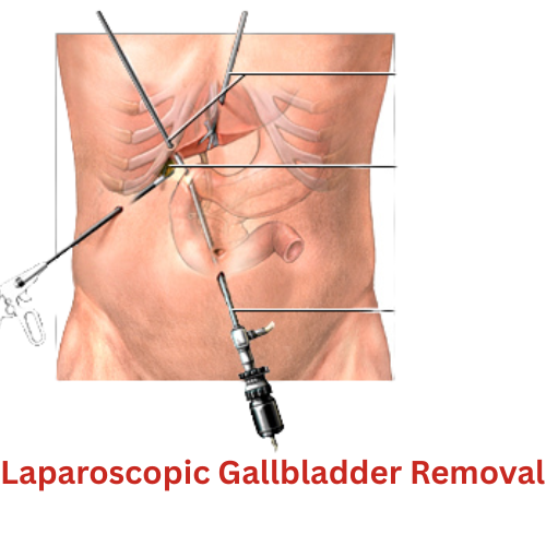 Laparoscopic Gallbladder Removal