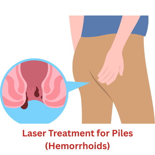Laser Treatment for Piles (Hemorrhoids)