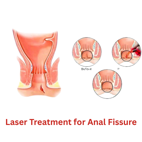 Laser Treatment for Anal Fissure