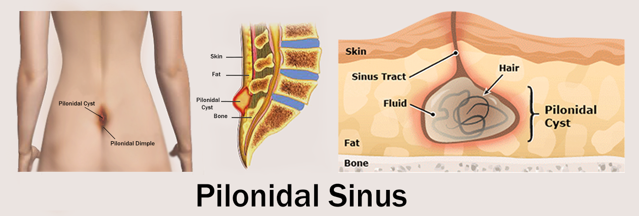 Laser Treatment for Pilonidal Sinus